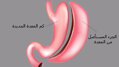 فوائد ومخاطر عملية تكميم المعدة