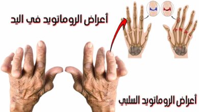 اعراض الروماتويد في اليد