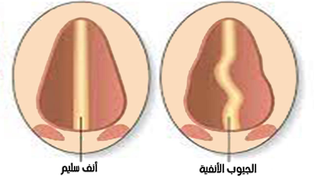 اعراض الجيوب الانفية