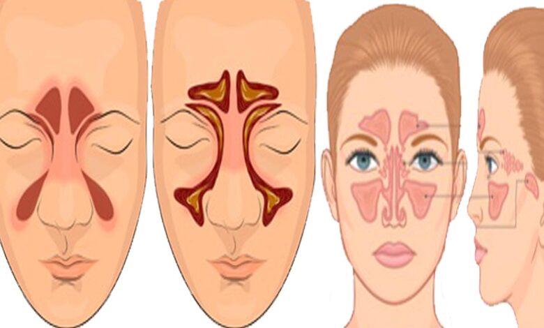 علاج صداع الجيوب الانفية