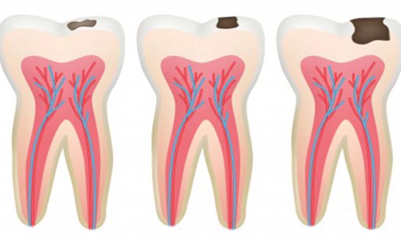 اعراض تسوس الاسنان وعلاجه